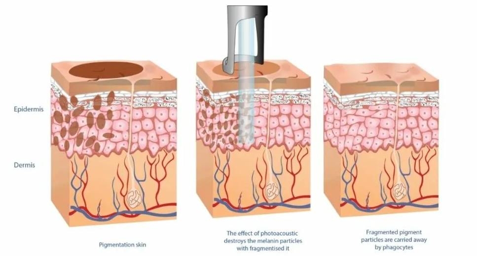 tattoo removal machine