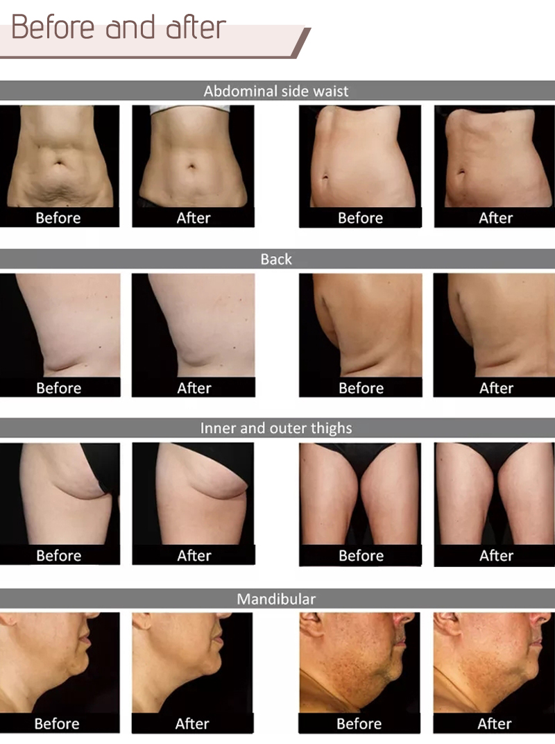 1060 diode laser slimming machine