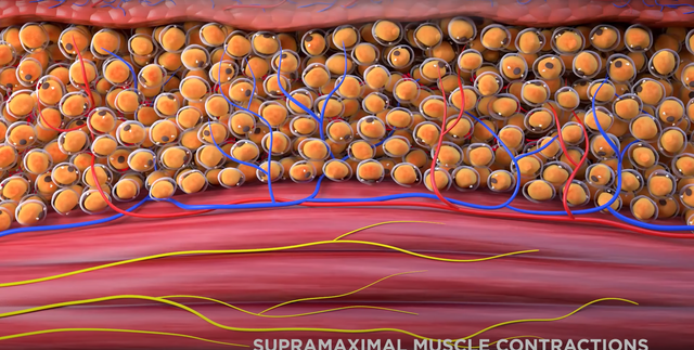 HIEMT EMS machine for sale