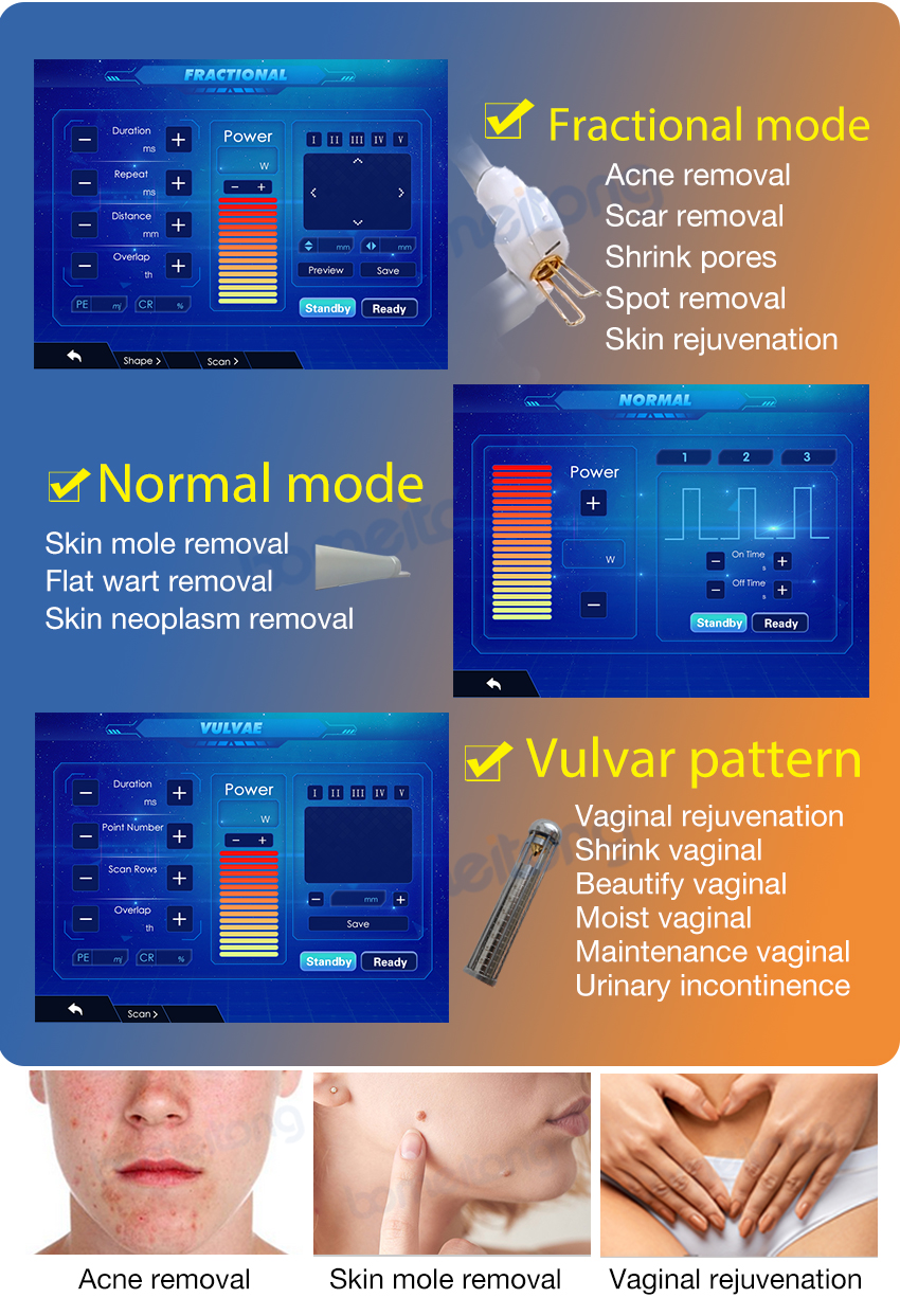 Laser Co2 Skin Resurfacing Facial Acne Scar Pore Speckle Removal Vaginal Tighten