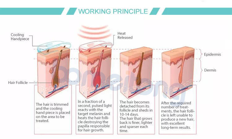 Laser hair removal principle