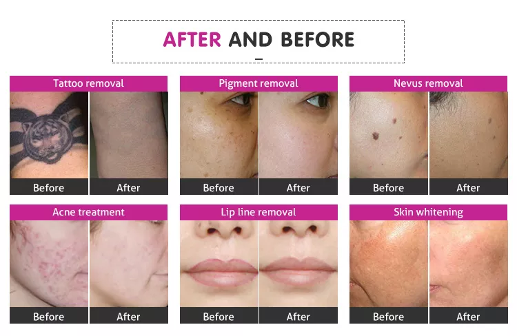 best tattoo removal laser