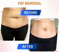 Body slimming hifu machine