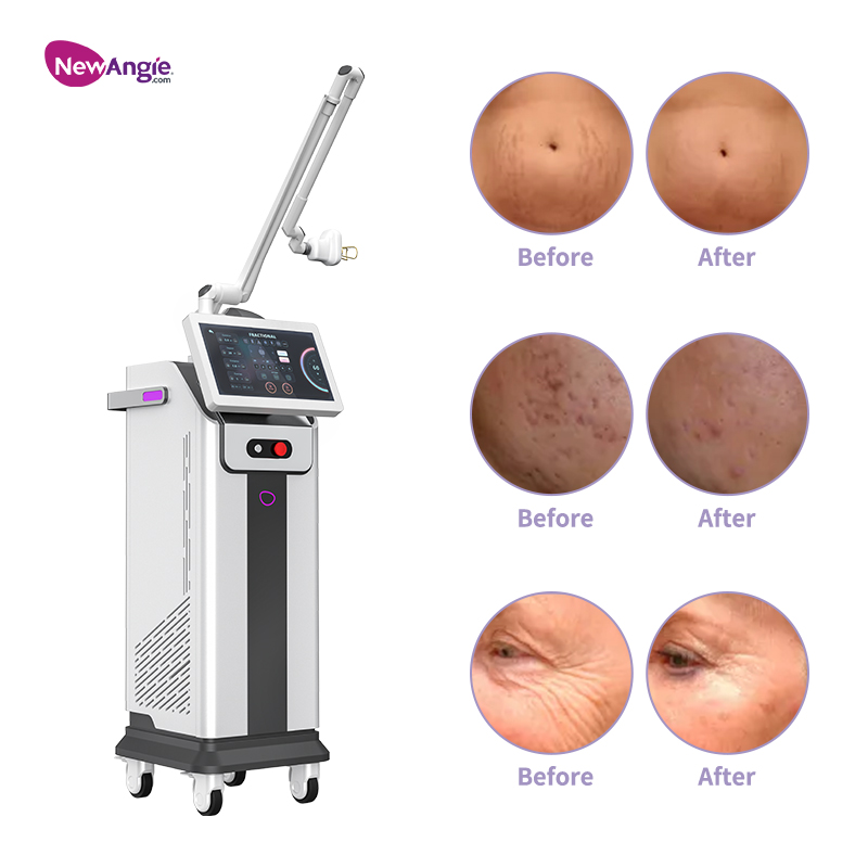 Fractional CO2 Laser Machine 60W Skin Rejuvenation Vaginal Tightening Laser Acne Scar Removal