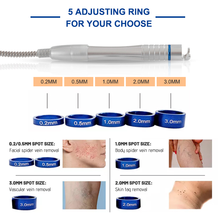 thread vein treatment nhs