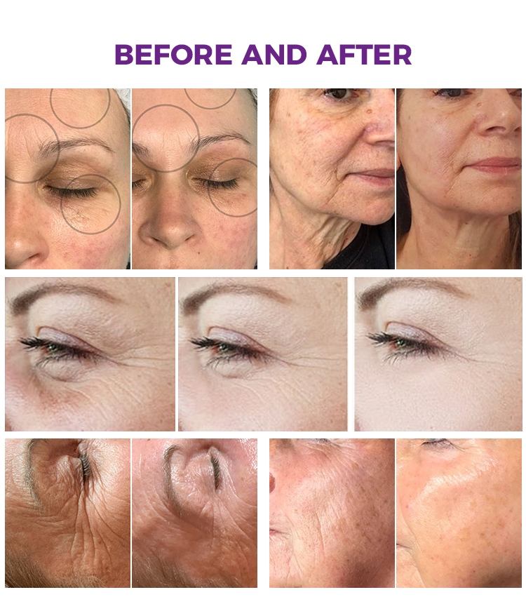 Pulselift face lifting