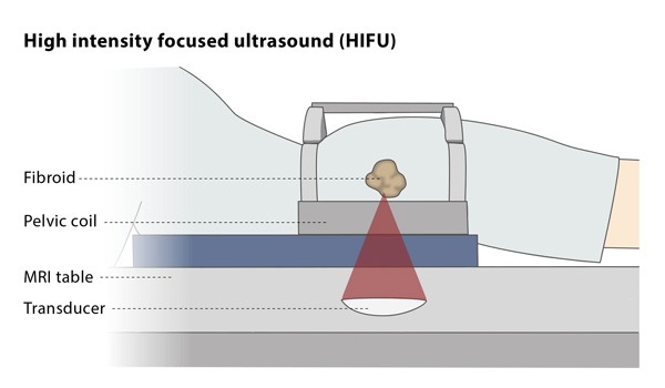 High Intensity Focused Ultrasound