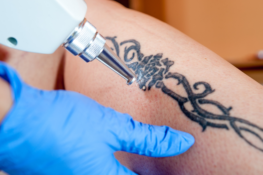 Picosecond Laser Tattoo Removal