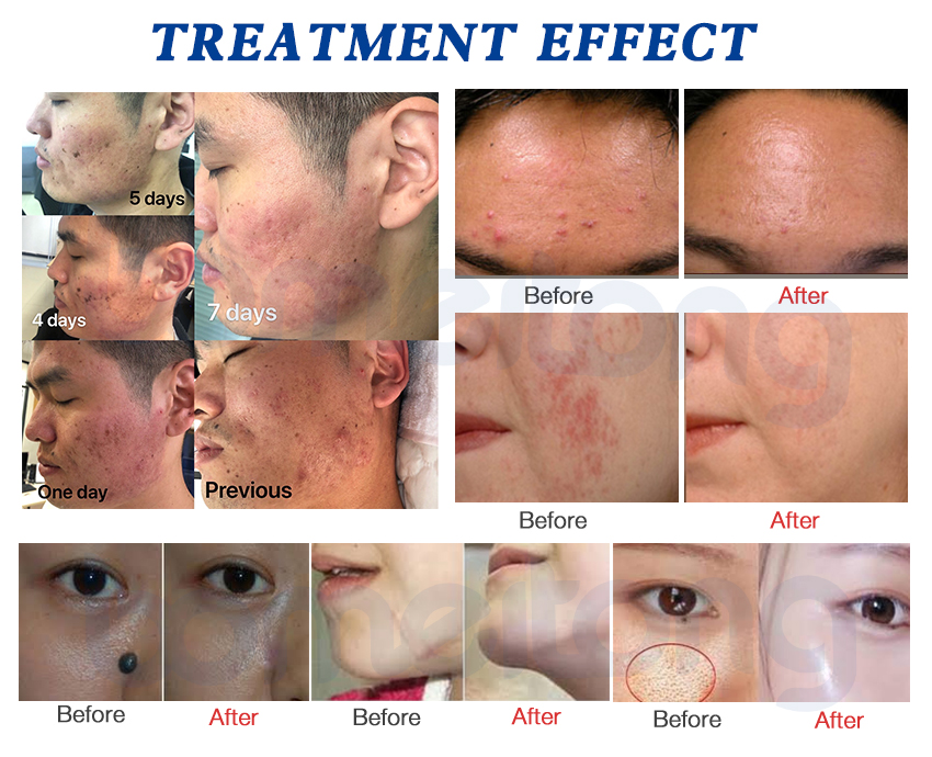 Fractional Co2 Laser Machine Cost Skin Resurfacing Acne Scars Stretch Marks Removal 