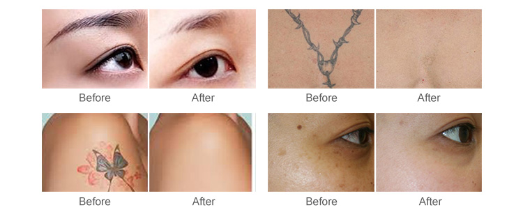 laser skin resurfacing cost