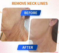 Wrinkle removal hifu machine