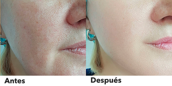 laser tattoo removal machine