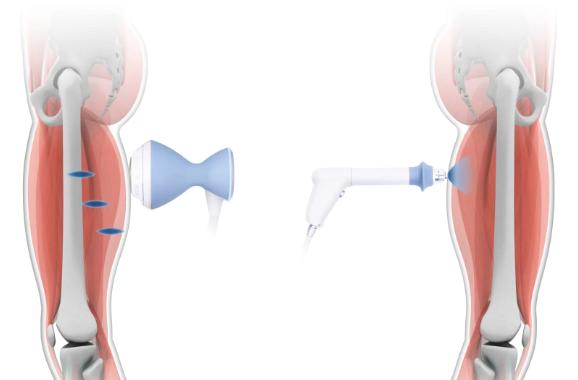 difference between focused shockwave therapy and radial shockwave therapy