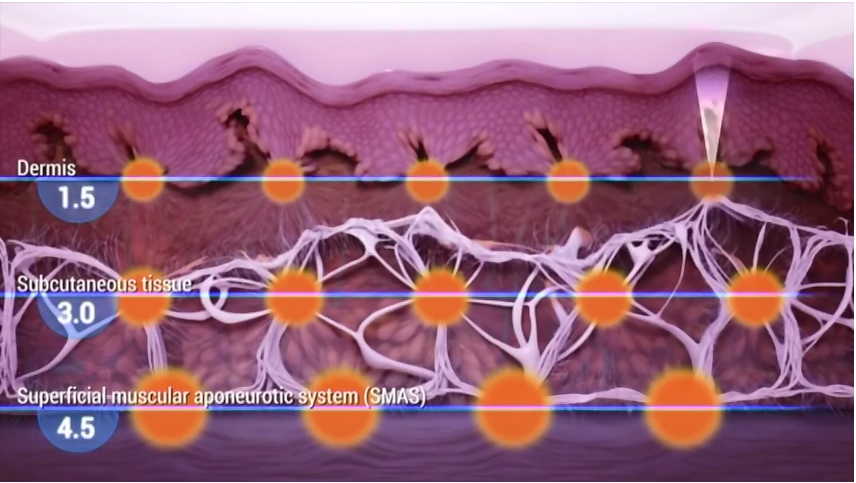 3 in 1hifu slimming machine