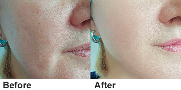 laser tattoo removal machine