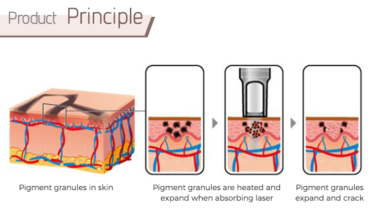 q switch nd yag laser machine