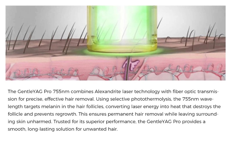 how GentleYAG Laser Pro works？
