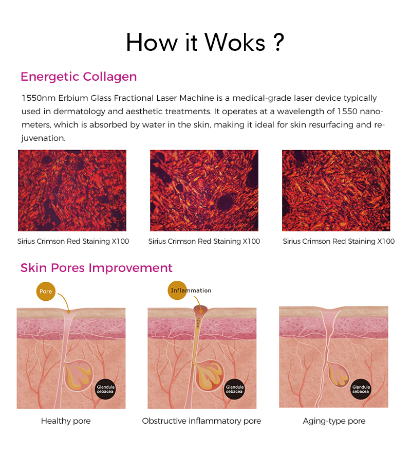 Erbium Lasers 1550nm Offer Effective Skin Resurfacing Solutions