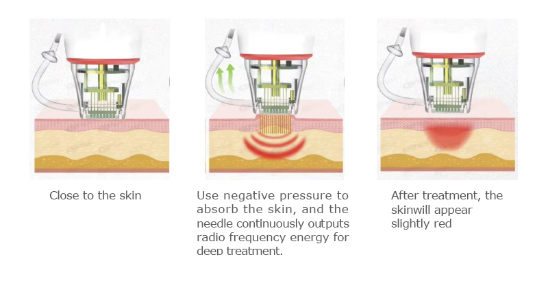 Buy Professional Fractional RF Microneedle Machine
