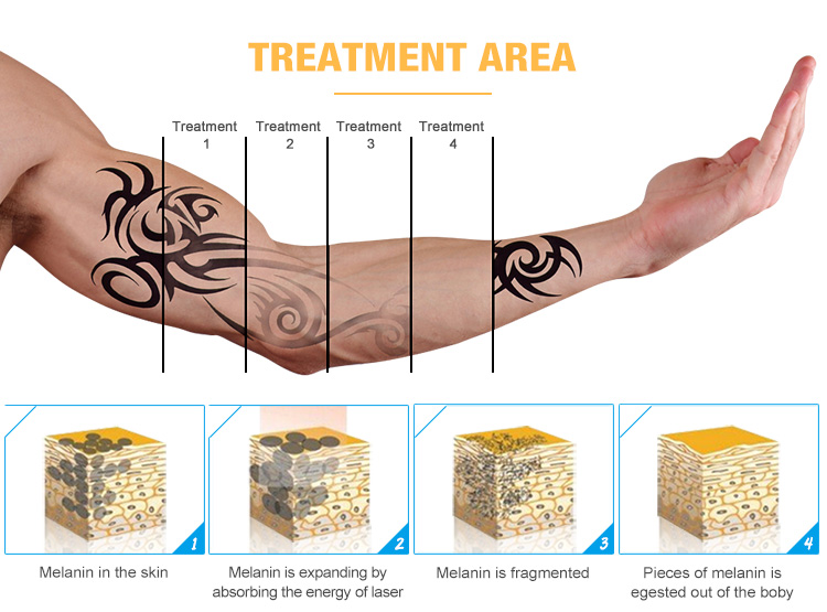 best tattoo removal laser