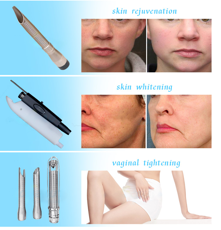 co2 fractionated laser resurfacing