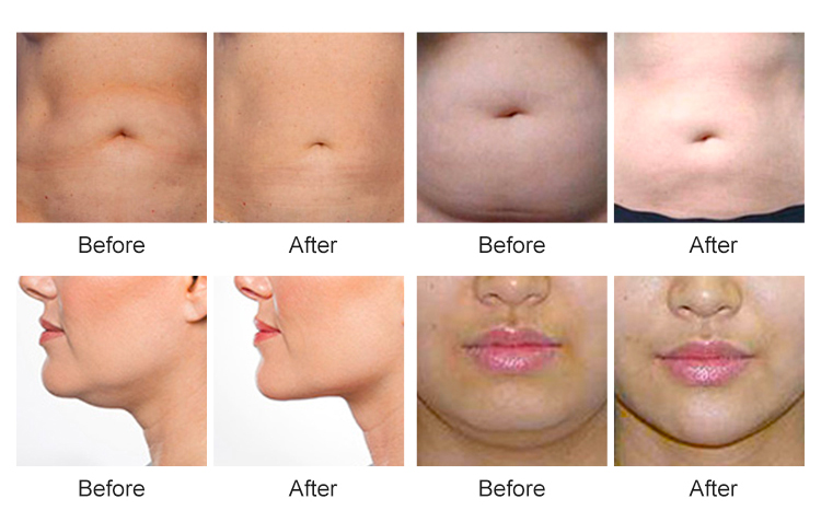 cryolipolysis weight loss machine