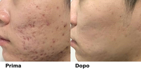 tattoo removal laser