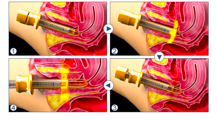 hifu vaginal tightening machine