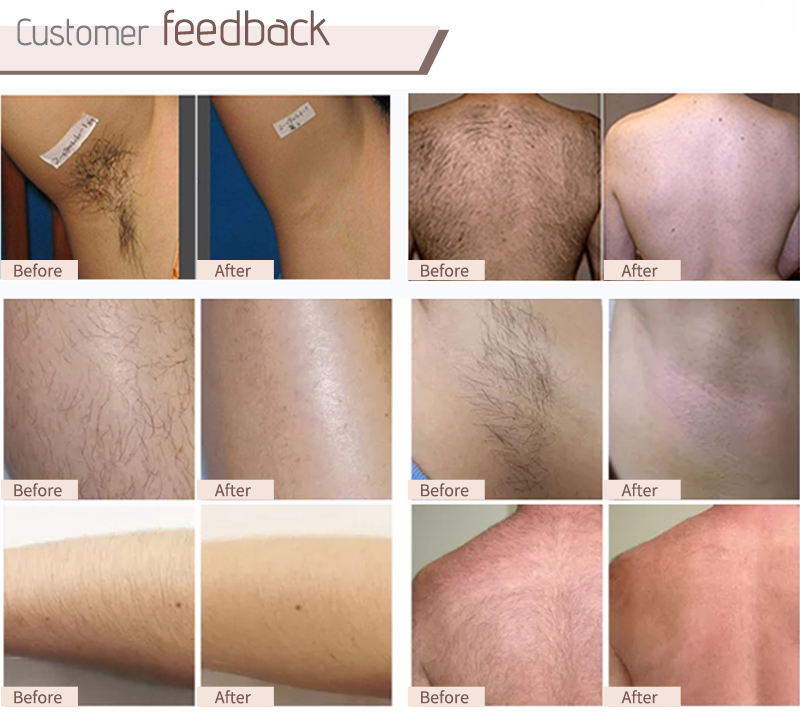 underarm laser hair removal