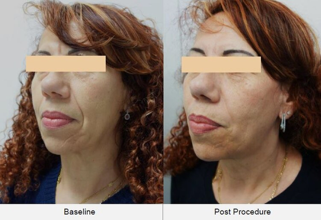 best hifu machine brands