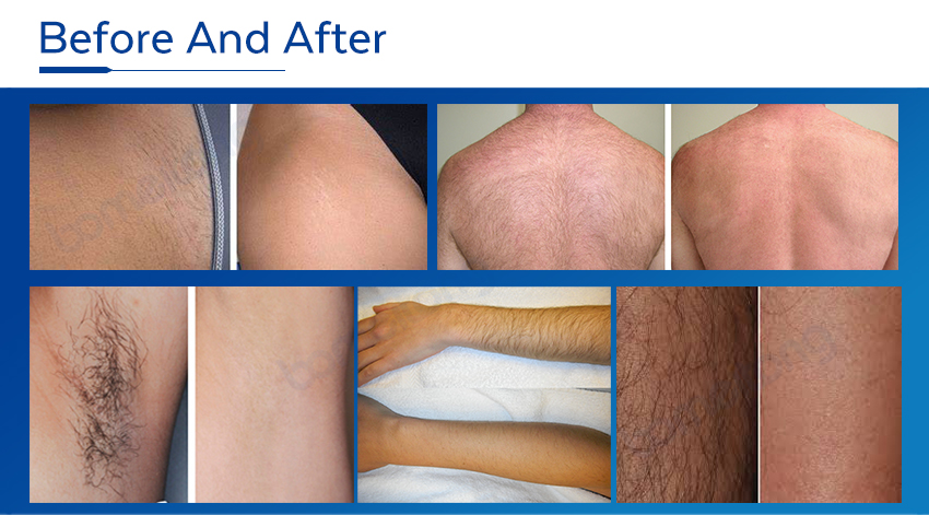 Laser hair removal diode machine 755 808 1064 3 wave wavelength professional