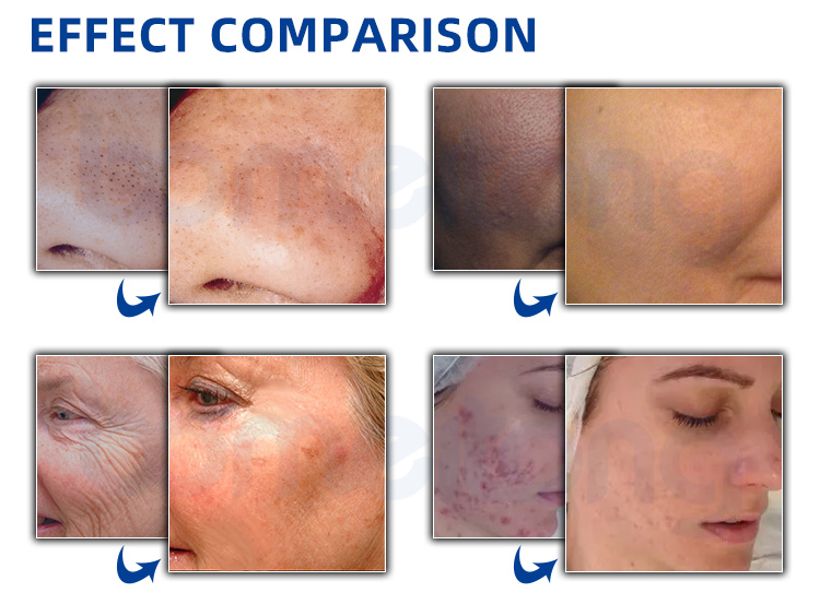 Hydro facial machine aqua peeling microdermabrasion water oxygen jet skin care