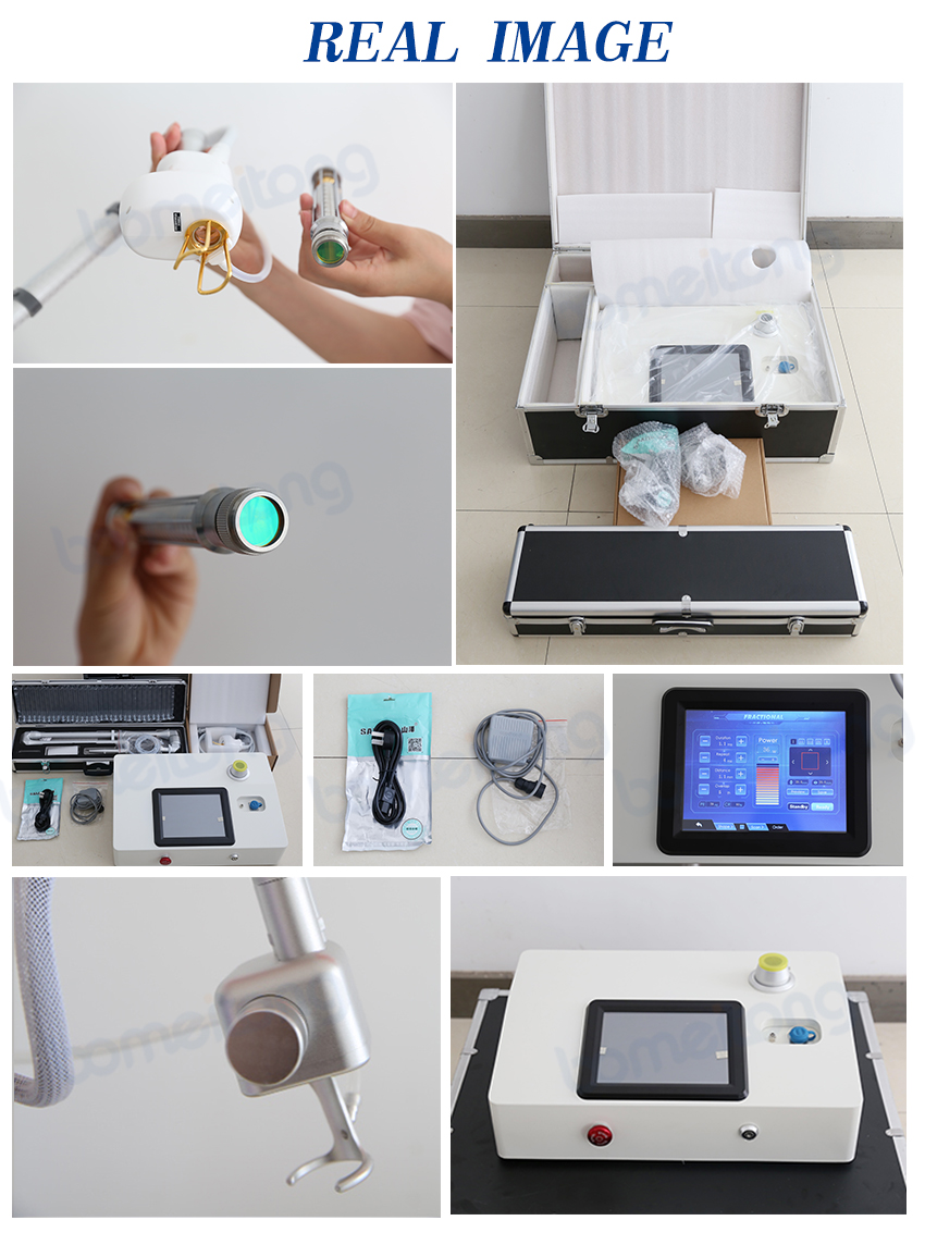 Laser Co2 Skin Resurfacing Facial Acne Scar Pore Speckle Removal Vaginal Tighten