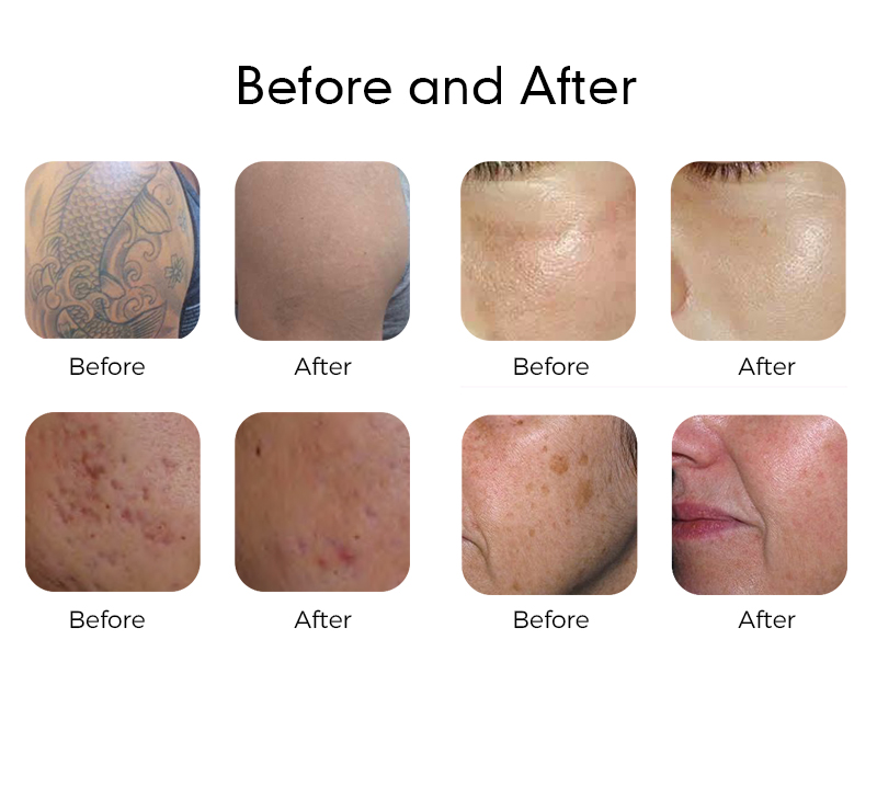 The 350ps True Pico Laser Treats Pigment Tattoos And Skin Issues