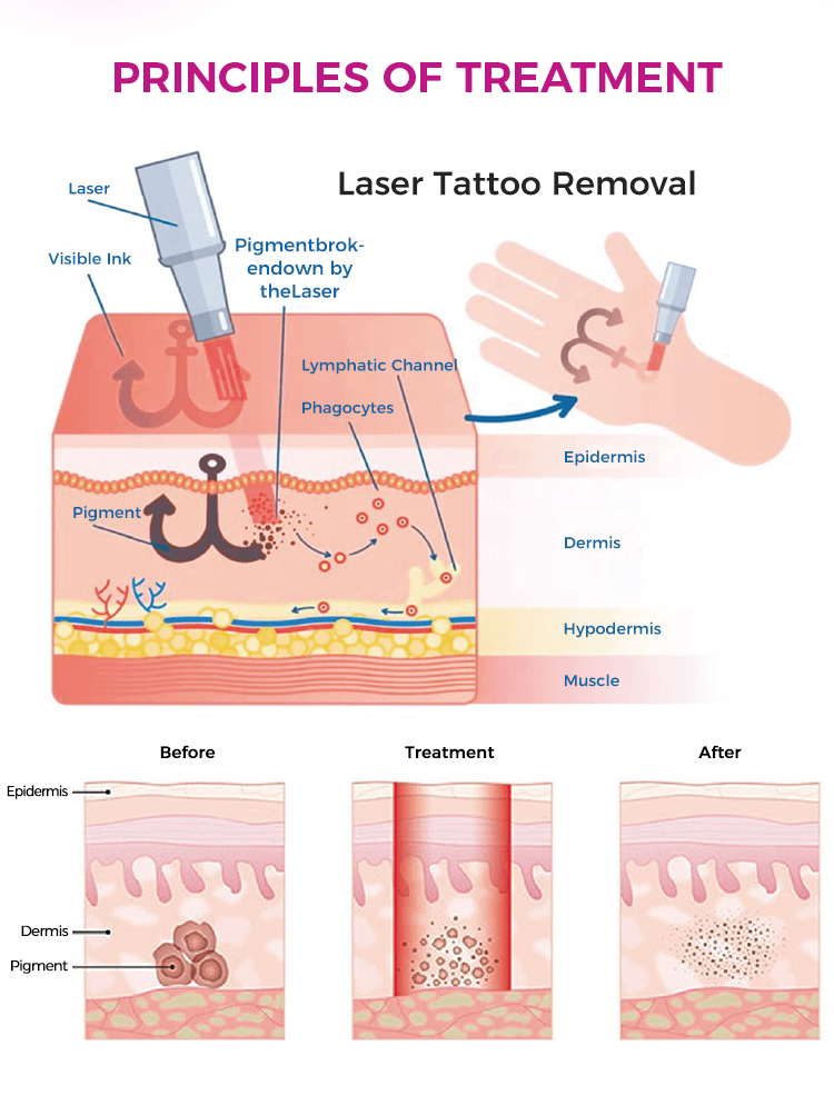 Q-switch Nd YAG Laser Machine From Suppliers for Tattoo Removal for Best Price