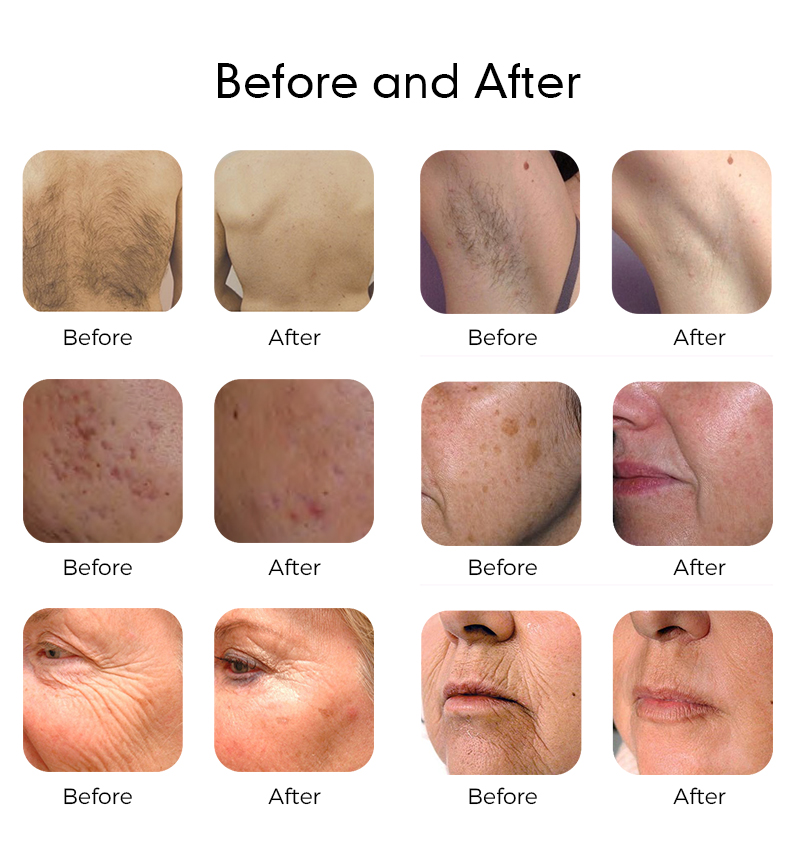 1927nm Thulium Fractional Laser Machine for Anti-Aging Face Lift And RF Therapy