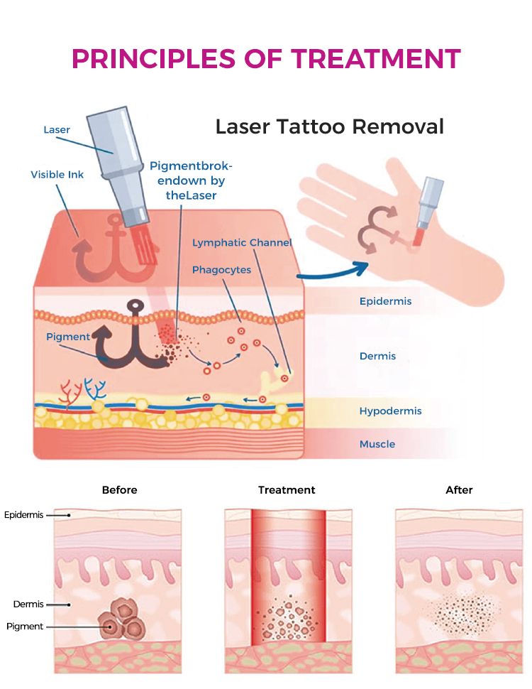 Q-switched Nd:YAG Laser Machine for Tattoo And Hair Removal
