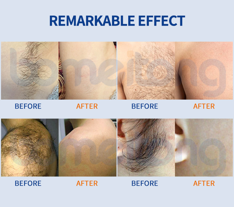 personal laser hair removal