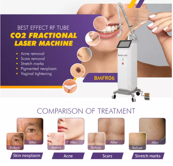 CO2 fractional laser machine