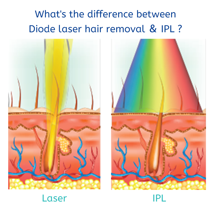 808nm diode laser hair removal machine