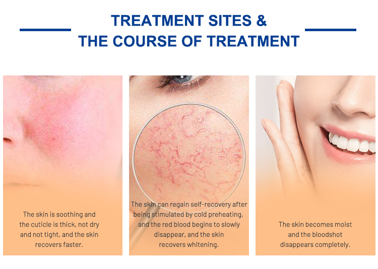 spider vein removal at home