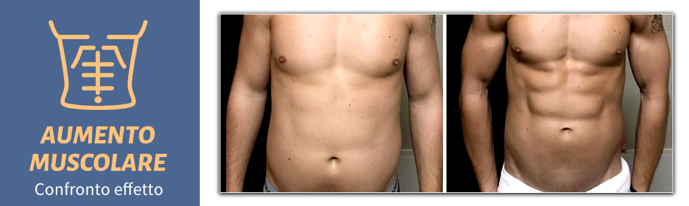 emsculpt body slimming