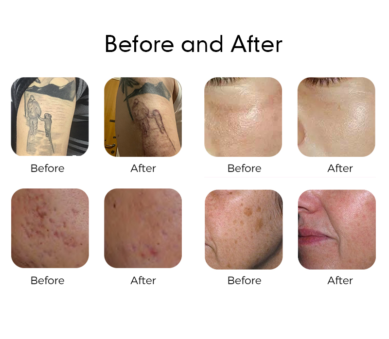 Pico & Nano Laser for Professional Use with Dual Pulse Mode 350ps PlCO + 2ns Nano 532nm 1064nm