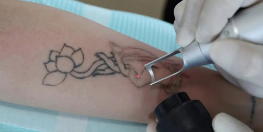 Top Benefits of Using Pico Laser Machines in Aesthetic Treatments
