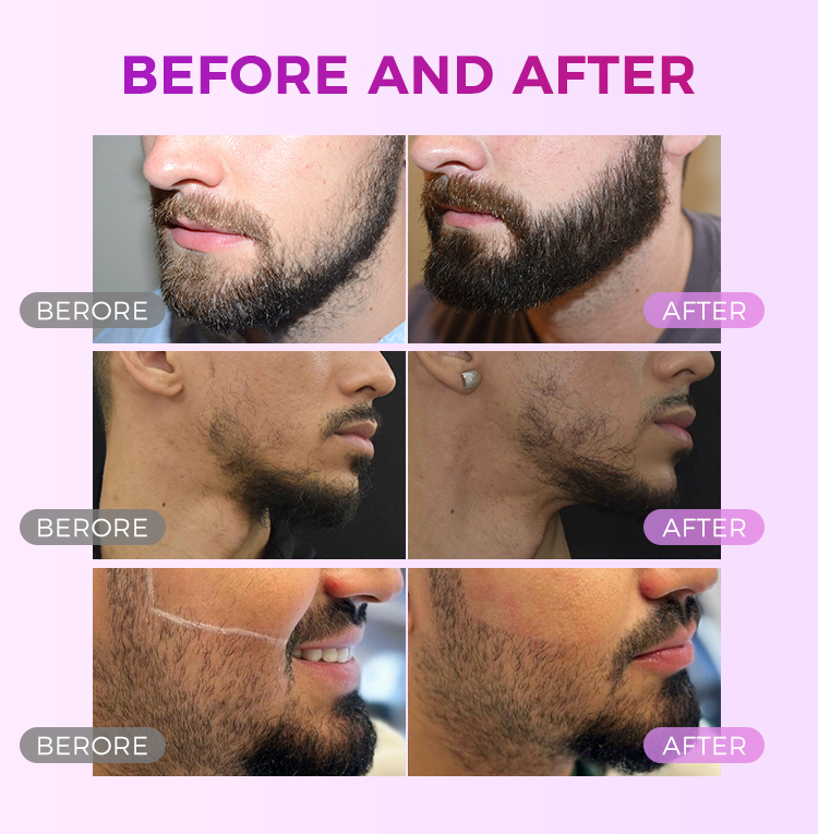 Best Laser Beard Removal Shaping for Men Permanent Treatment with Facial Laser