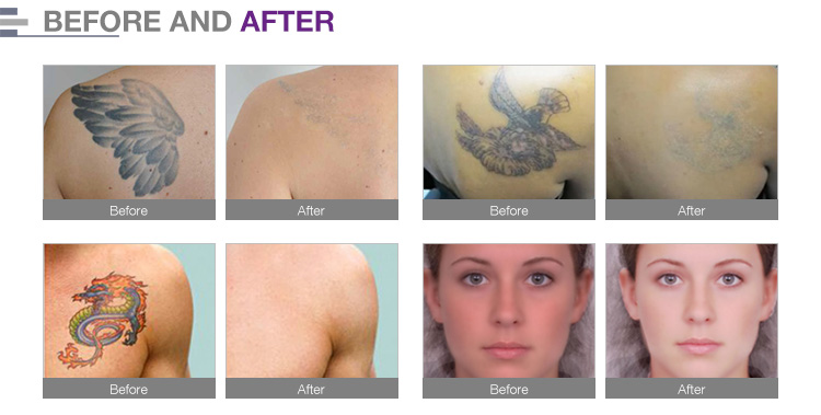 laser treatment for freckles