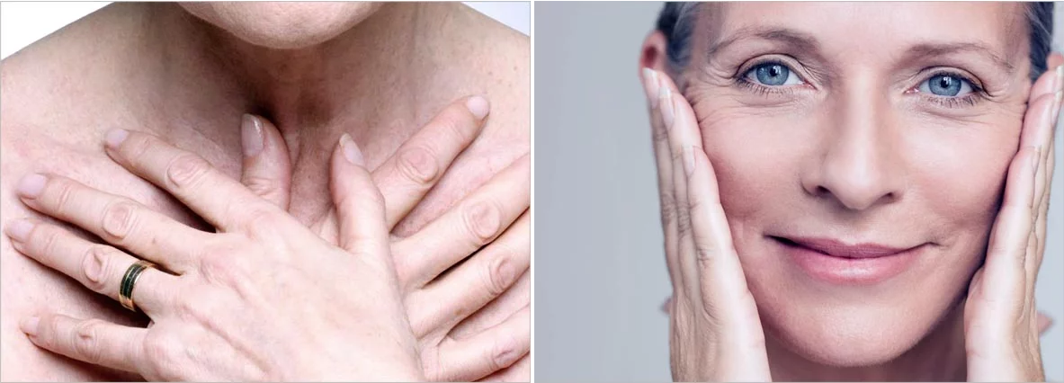 hifu treatment effect