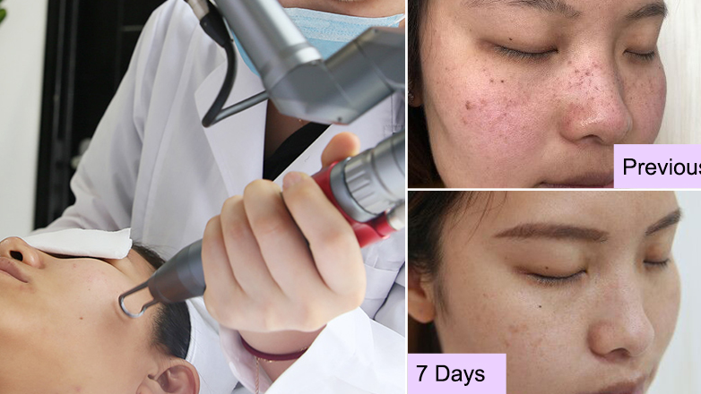 laser tattoo removal machine