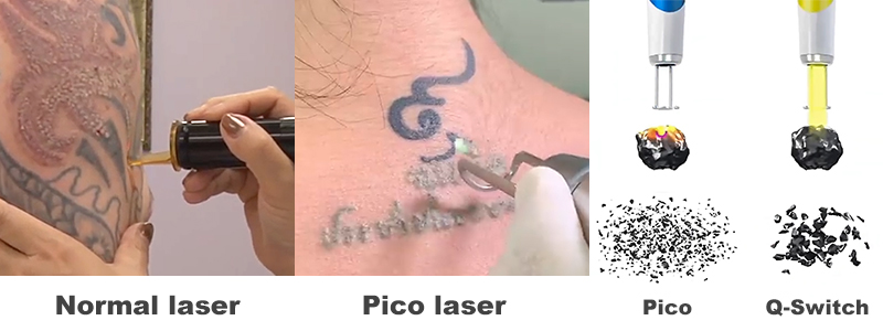 pico laser tattoo removal