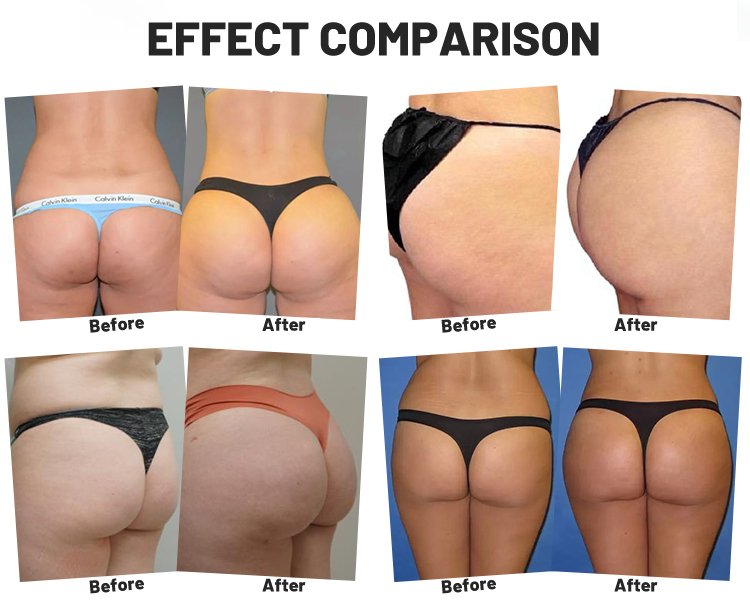 Pelvic floor muscle repair